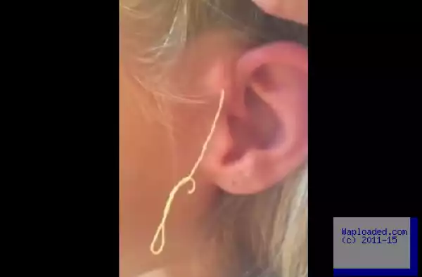 SEE What Came Out When Girl Popped Giant 6-Year Old Pimple